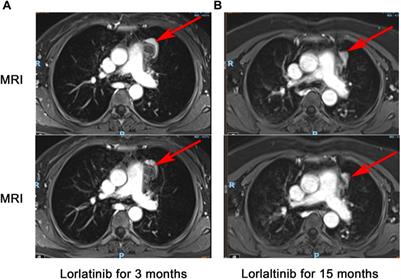 A case report: Pathological complete response to neoadjuvant lorlatinib for Epithelioid inflammatory myofibroblastic sarcoma with EML4-ALK rearrangement